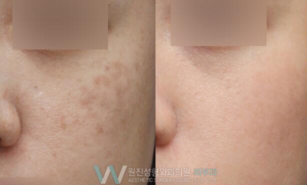 韩国皮肤斑点治疗方案