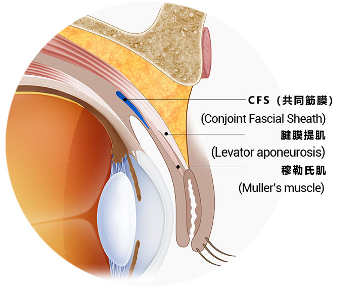 CFS （共同筋膜）眼型矫正照片