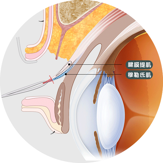 CFS共同筋膜眼部矫正手术