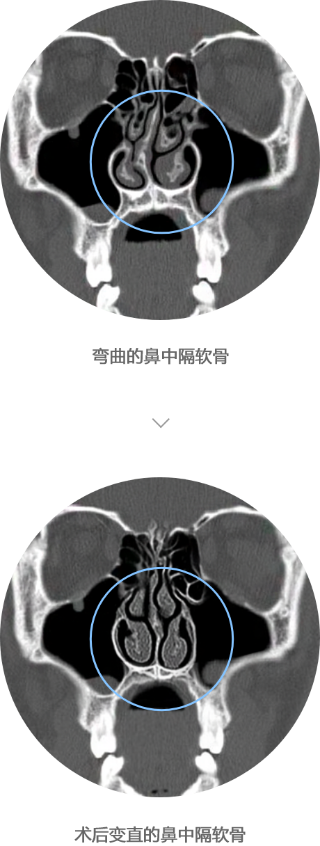 鼻中隔弯曲症患者的CT照片