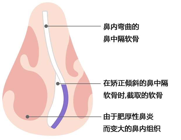 鼻子内部弯曲的鼻中隔软骨，矫正弯曲的鼻中隔软骨时获得的软骨，因肥厚性鼻炎而肥大的鼻子内的肉组织图像