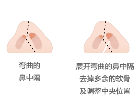 Step1. 矫正弯曲的鼻中隔