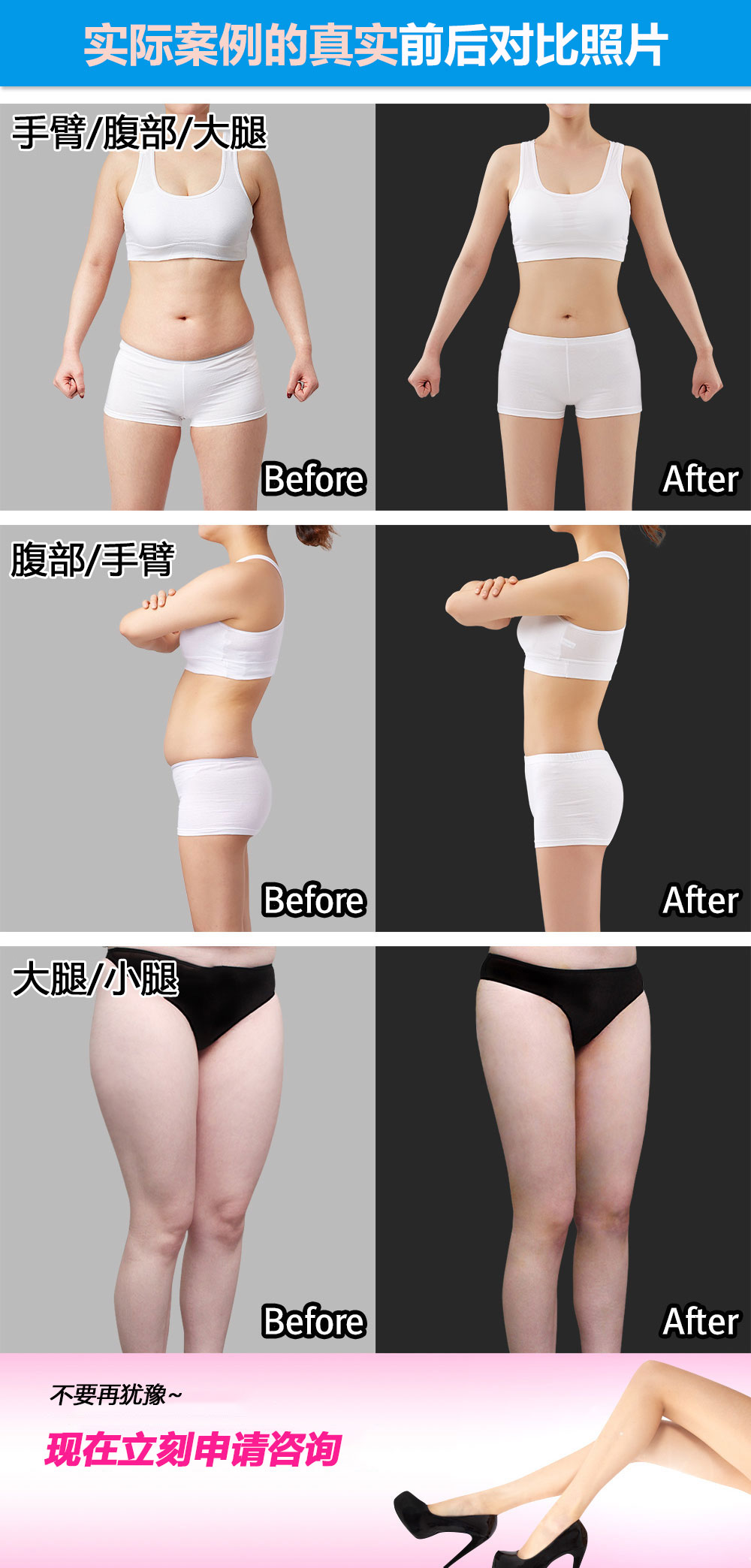 지방흡입 전후사진