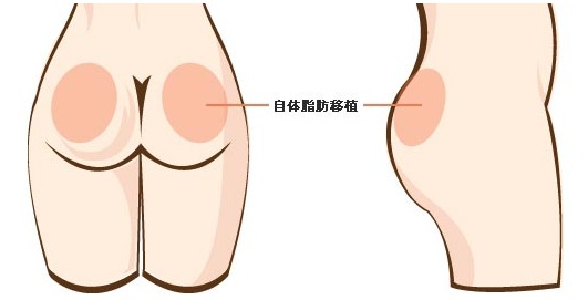 自体脂肪丰臀好不好？