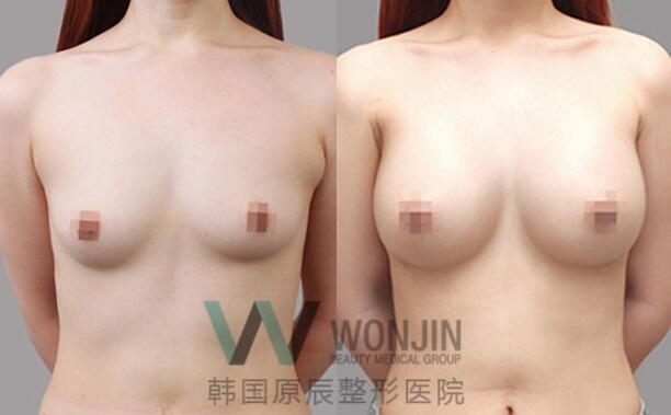 韩国胸部整形