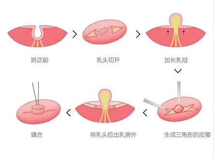 韩国乳头凹陷