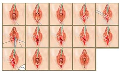 韩国阴道整形