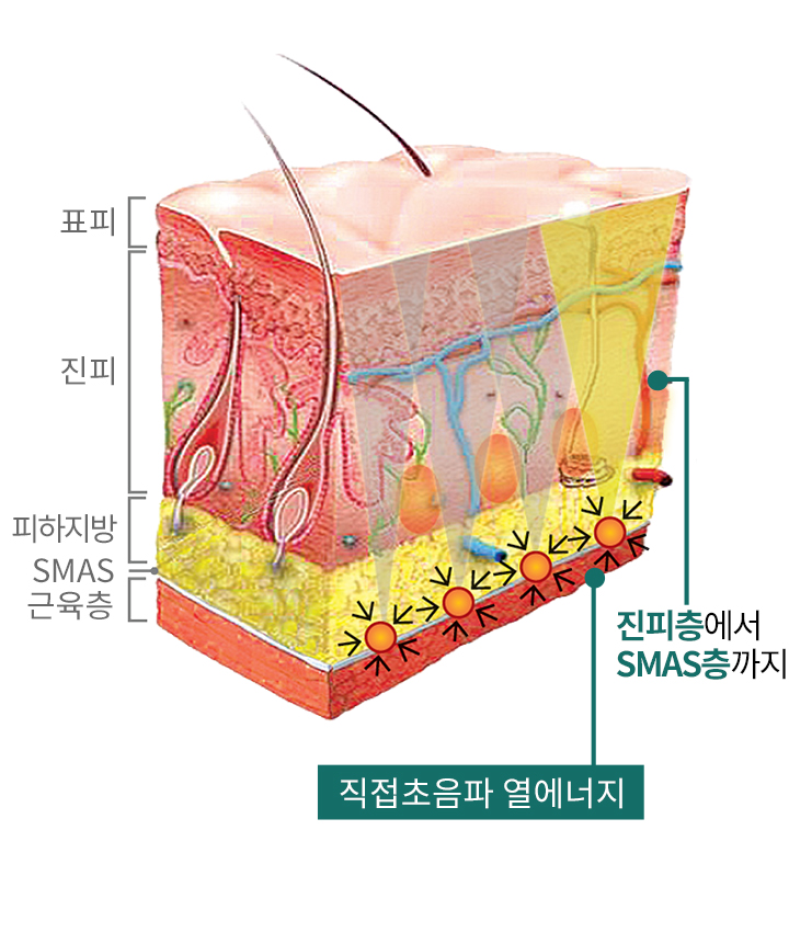 超声能量聚焦原理图