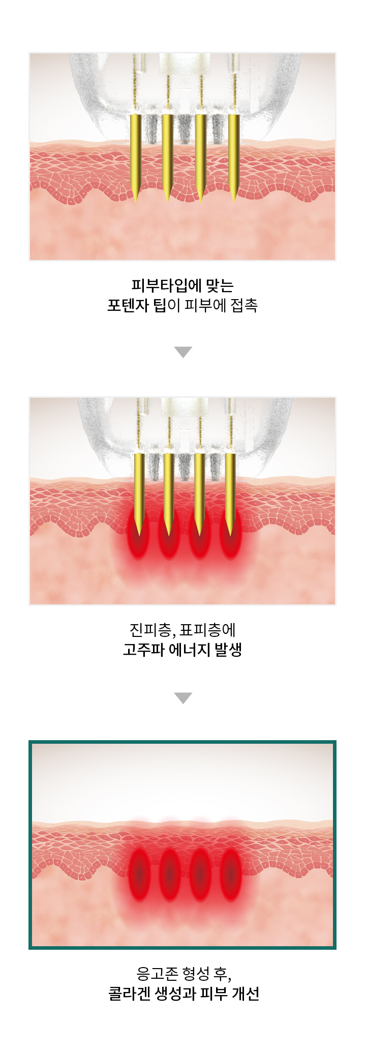 微针深度调节及能量传导示意图