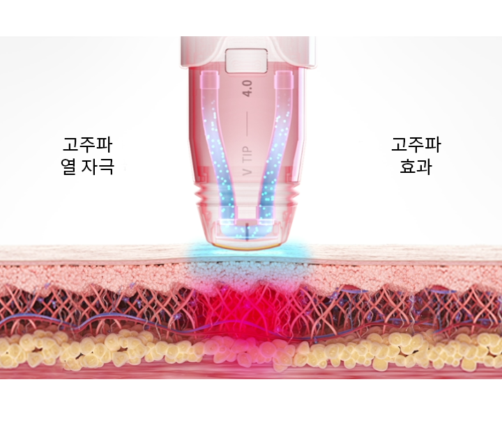 射频能量皮肤作用层次示意图